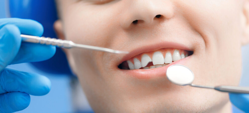 Tyggeskade. Tandforsikring. Få dækning for skader på dine tænder.